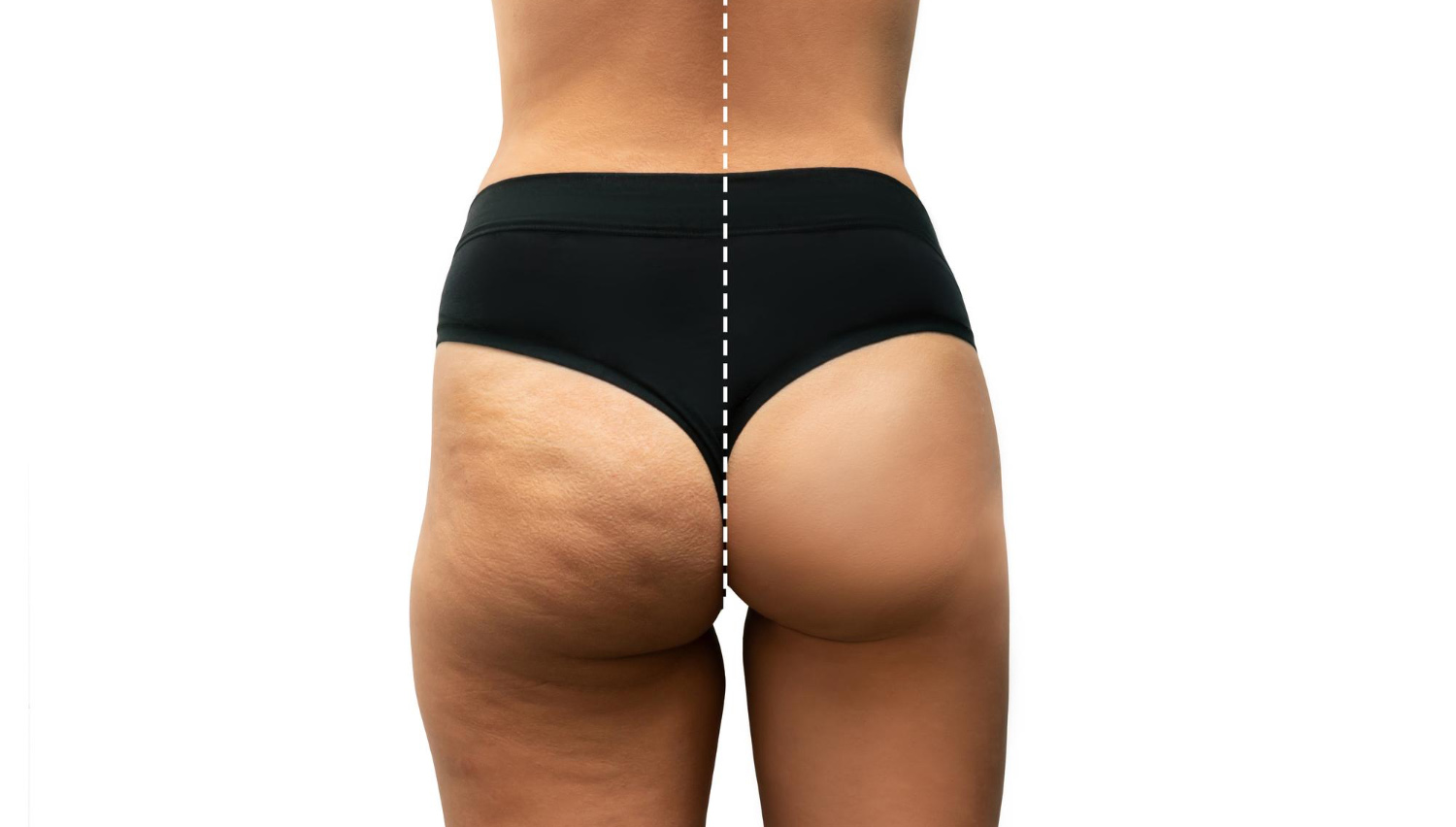 What is Brazilian Buttock Lift?